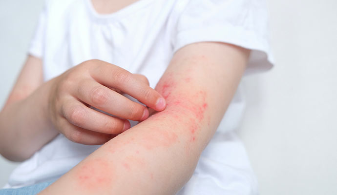 a boy is affected by allergen